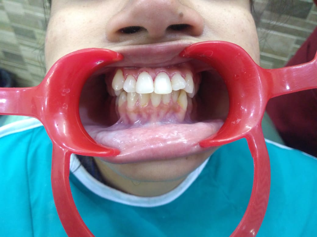 Cosmetic smile correction after