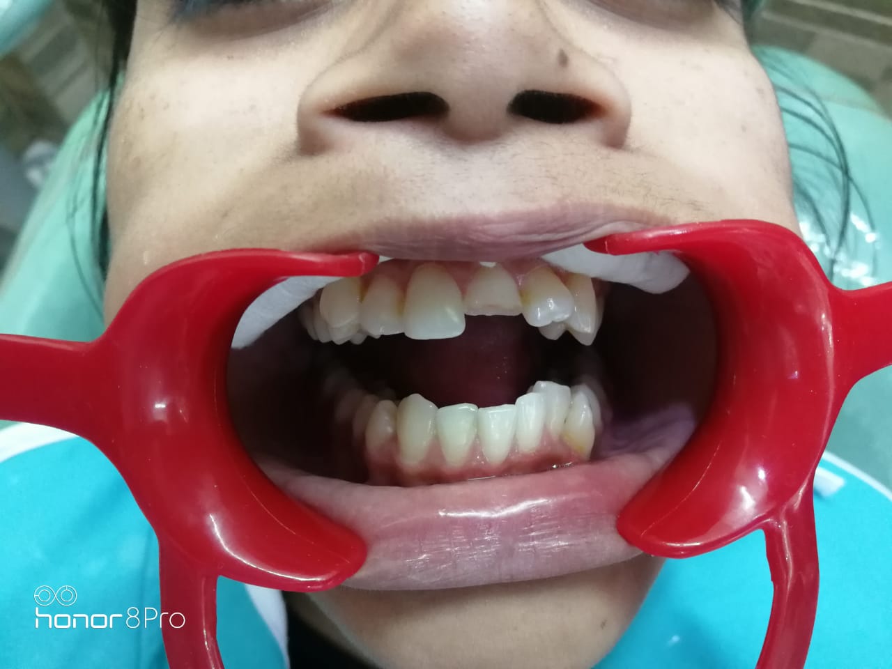Cosmetic smile correction before