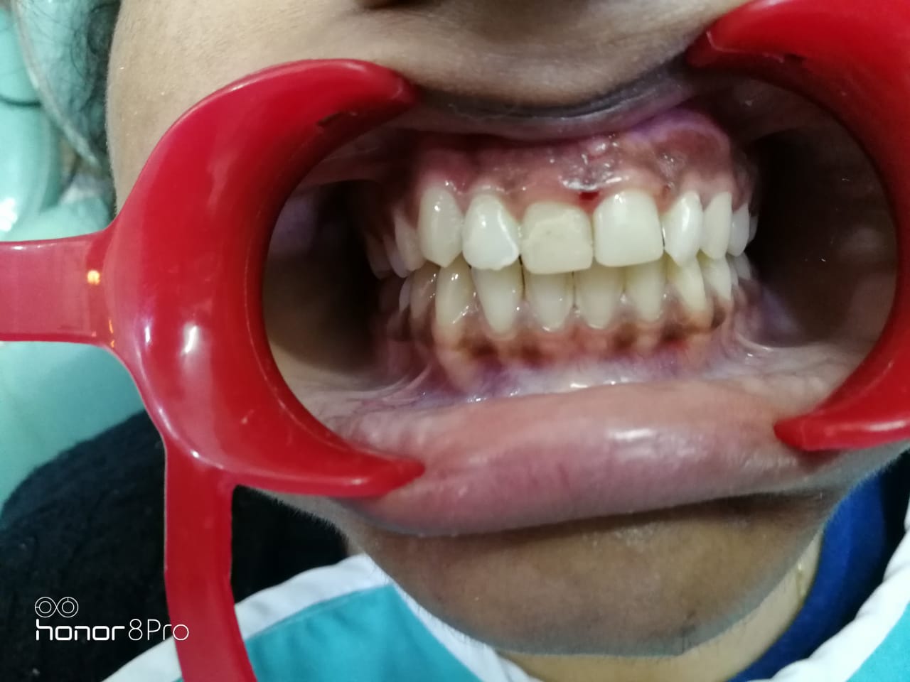 Aesthetic dental makeover after