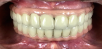 Full mouth rehabilitation with dental implants after