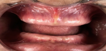 Full mouth rehabilitation with dental implants before