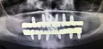 Full mouth rehabilitation with dental implants X-ray