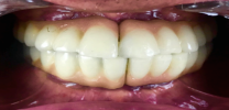 12 implants and 24 units of bridges after