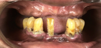 12 implants and 24 units of bridges before