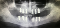 12 implants and 24 units of bridges X-ray