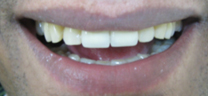Cosmetic tooth-colored fillings after