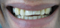 Cosmetic tooth-colored fillings before