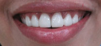 Gap closure after