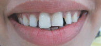 Gap closure before