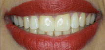 Metal-free crowns after