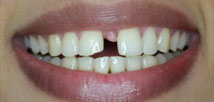 Metal-free crowns before