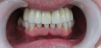 Full upper arch restored with 8 implants after