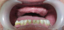 Full upper arch restored with 8 implants before