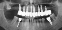 Full upper arch restored with 8 implants X-ray