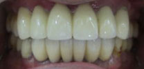 Lower front teeth restored with 3 implants after