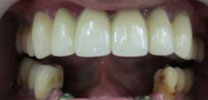 Lower front teeth restored with 3 implants before