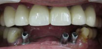 Lower front teeth restored with 3 implants Implant