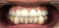 Upper full arch with 7 implants and Malo bridge after