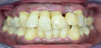 Upper full arch with 7 implants and Malo bridge before