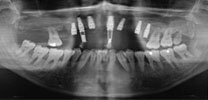 Upper full arch with 7 implants and Malo bridge X-ray