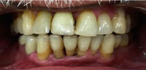 Front lower tooth replaced with an implant after