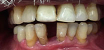 Front lower tooth replaced with an implant before