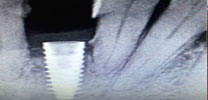 Front lower tooth replaced with an implant X-ray