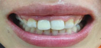 Multiple upper front teeth restored with implants after