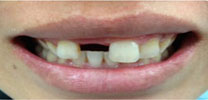 Multiple upper front teeth restored with implants before