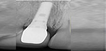 Multiple upper front teeth restored with implants X-ray