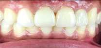 Multiple missing front teeth restored with implants after