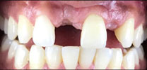 Multiple missing front teeth restored with implants before