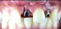 Multiple missing front teeth restored with implants Implant