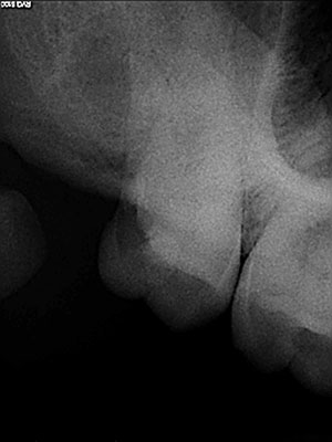 Root canal treatment before