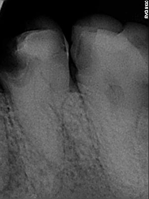 Root canal treatment after