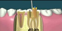 RCT case sequence During