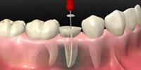 RCT case sequence after