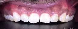 ZOOM teeth whitening after