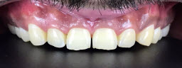 ZOOM teeth whitening before
