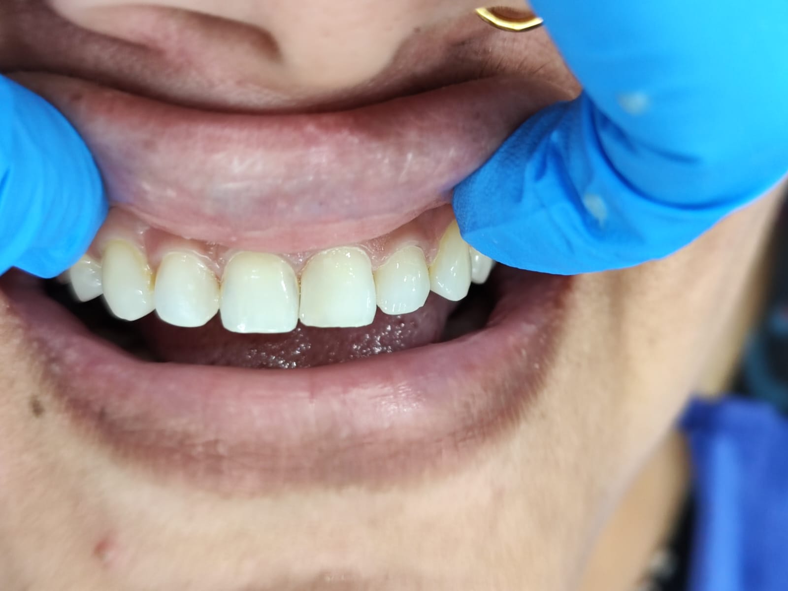 Case 1 after