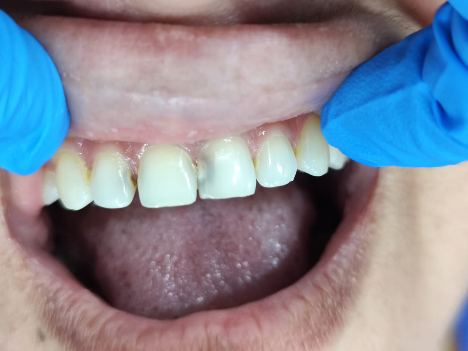 Case 1 before