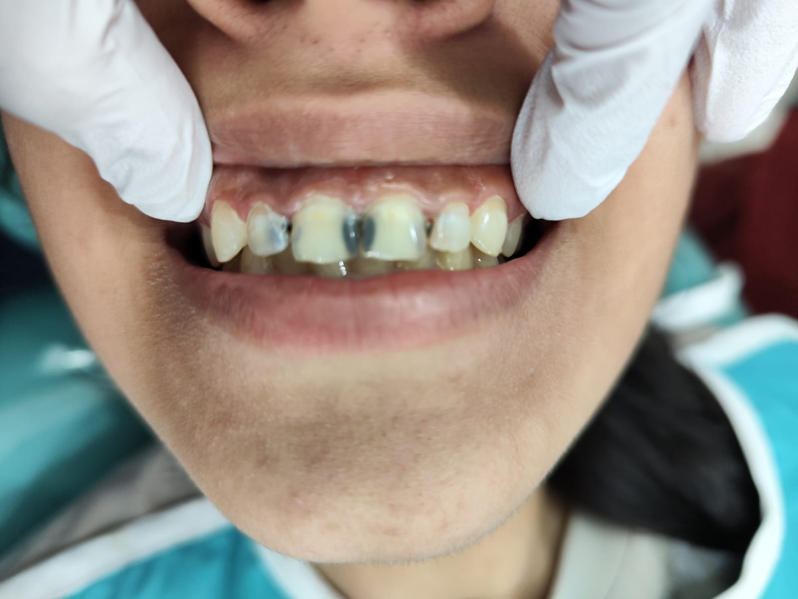 Case 10 before