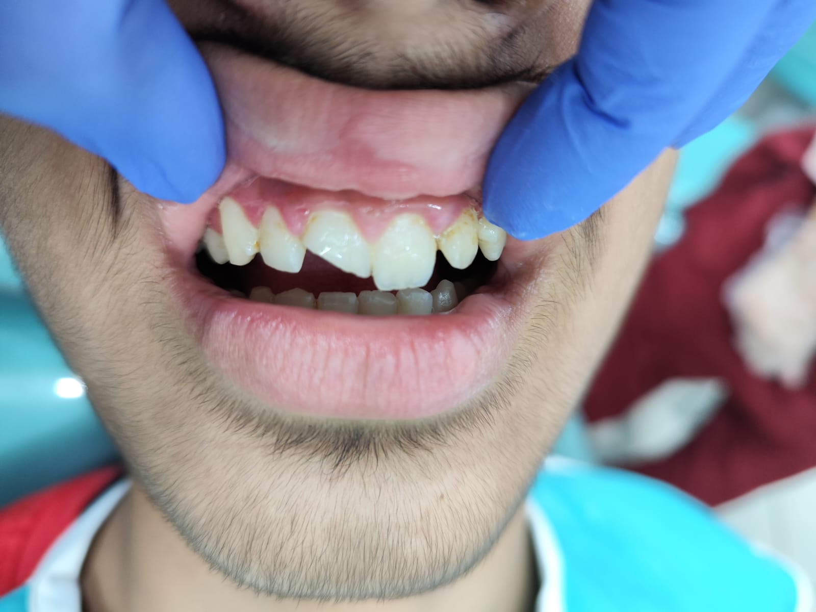 Case 11 before