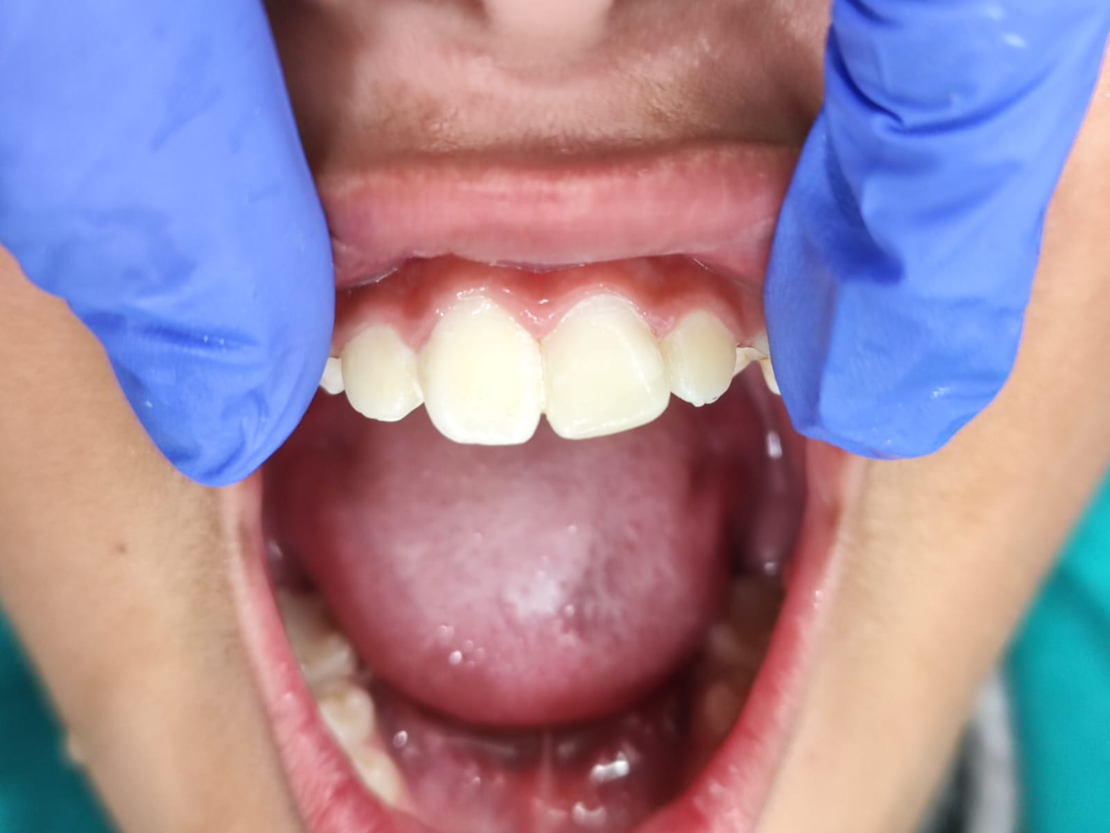 Case 4 after
