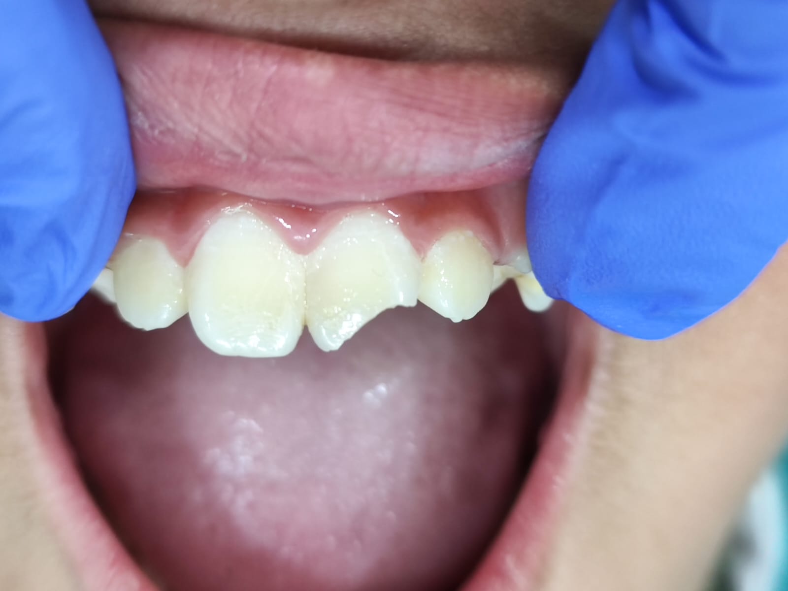 Case 4 before