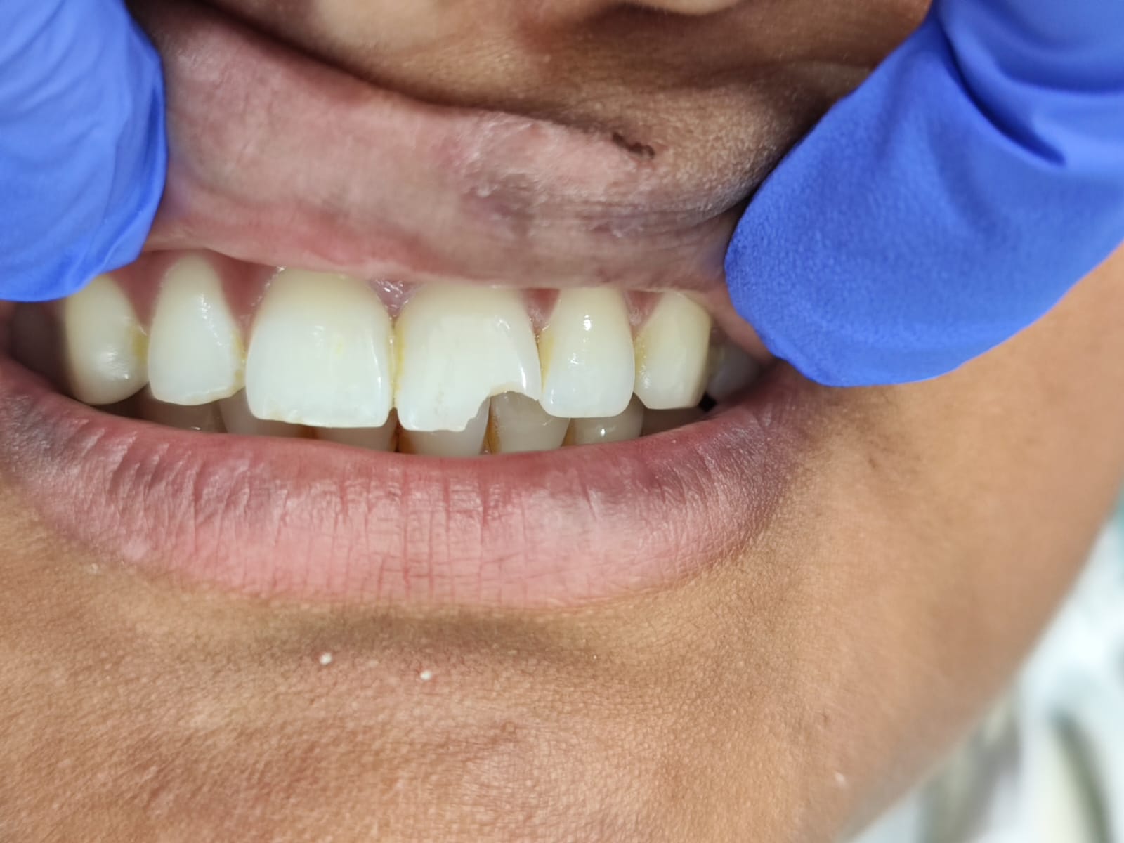 Case 5 before