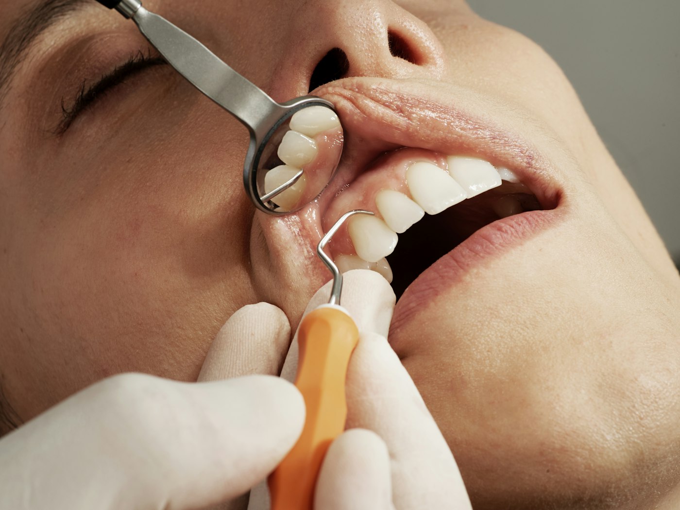 Tooth colored fillings