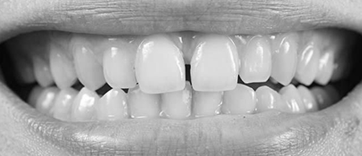 Gap closure