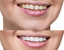Gap closure