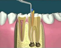 Root canal treatment